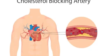 signs of blocked arteries