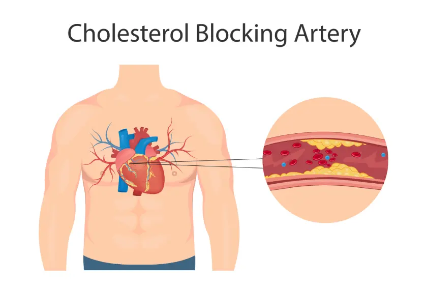 Discover symptoms of blocked arteries, causes of clogged arteries, and foods that help unclog arteries and improve heart health.