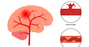 carotid artery disease strokes