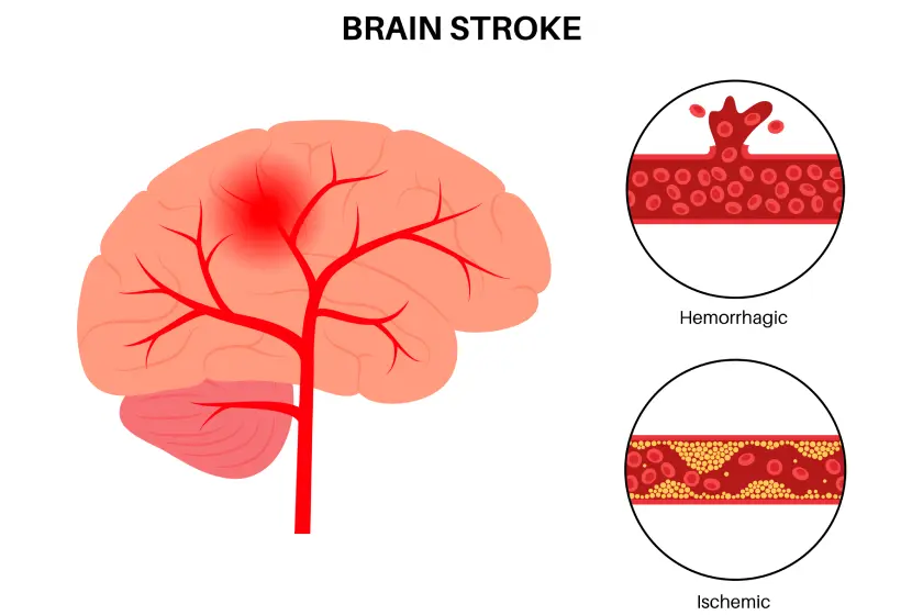 Understand carotid artery disease, types of strokes, mini stroke symptoms, and how to prevent serious complications.