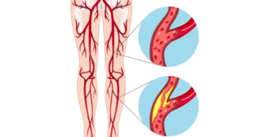 pad legs treatment