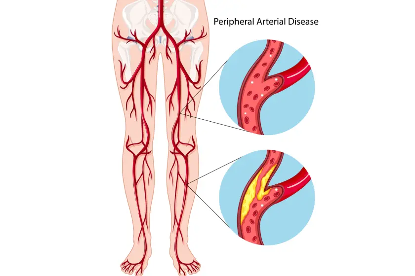 Learn how diabetes affects PAD treatment, recovery time, and outcomes. Understand symptoms, treatment options, and tips for better healing in diabetic patients.
