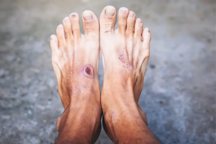 Why Diabetic Foot Problems Increase During Monsoon